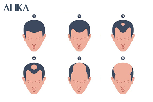 Hói đầu sớm ở nam giới là dấu hiệu của bệnh gì  Cấy Ghép Tóc Tóc Y Học  Quốc Tế